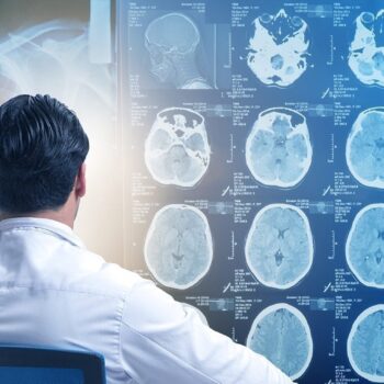 irm cerebral 1