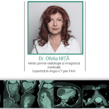 echipa angio-ct coronarian