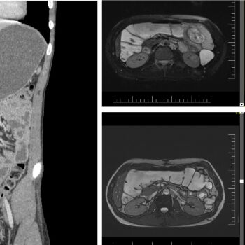 Analize pentru boli inflamatorii intestinale