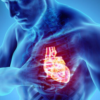 infarct de miocard