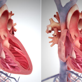 right side heart failure