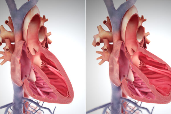 right side heart failure