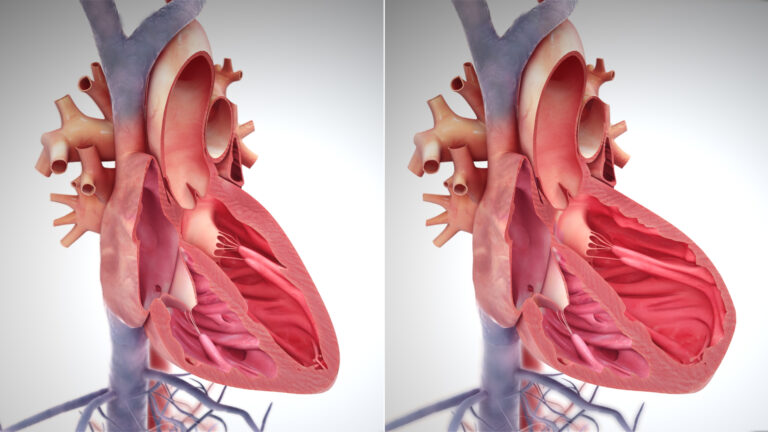 right side heart failure